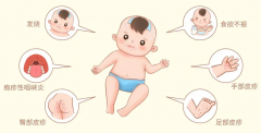 手足口病会传染吗 怎么预防手足